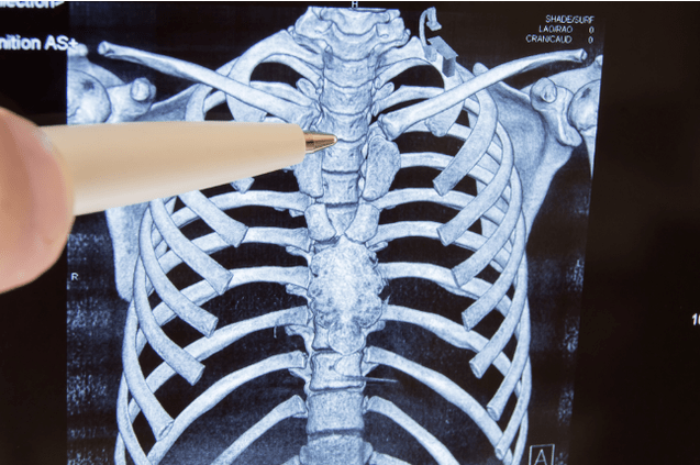Osteochondral disease