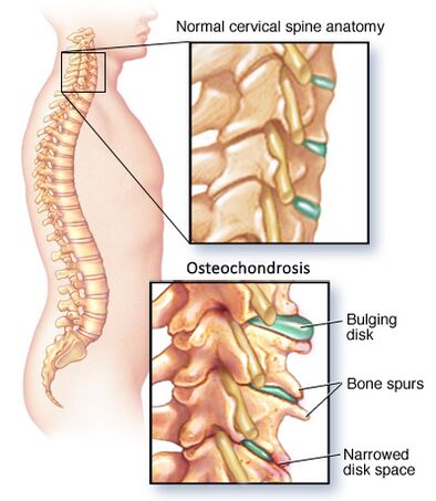 Neck bone and chondropathy