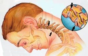 Cervical
