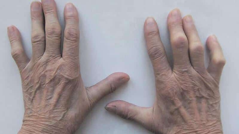 How to treat joint pain in your fingers