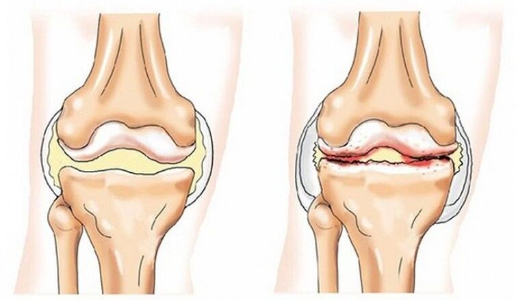 Healthy joints and joints are affected by joints