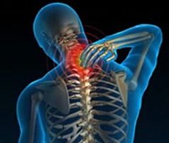 cervical osteochondrosis