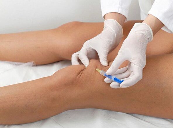 Intra-articular injection of knee