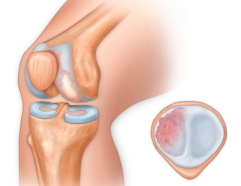 What does arthritis in the knee look like