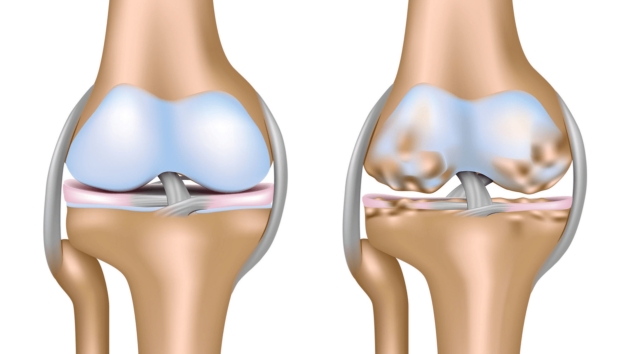 knee osteoarthritis