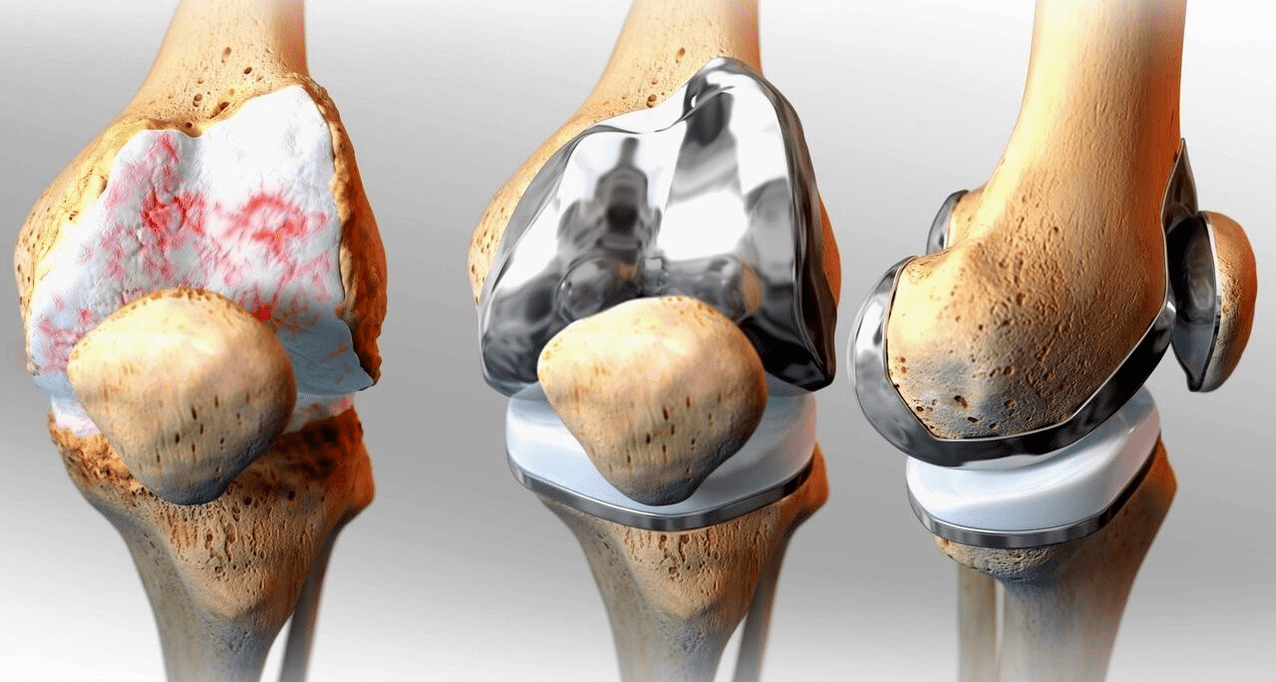 knee replacement surgery