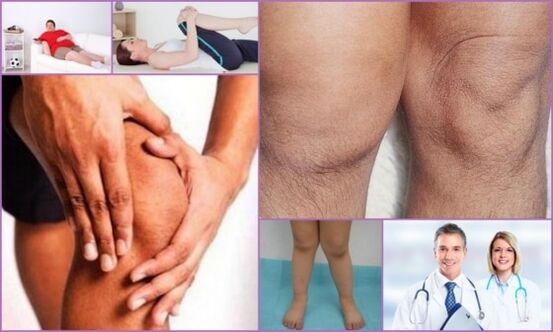 Symptoms of knee joint disease