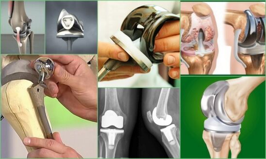 knee replacement surgery