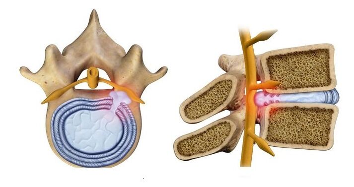 Intervertebral disc herniation - herniation of the disc nucleus into the spinal canal