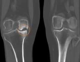 right knee joint disease